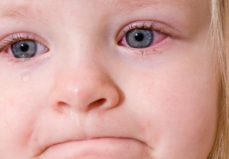 Picture of a child with Conjunctivitis